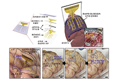 뇌질환 치료의 전환점, 전자패치-초음파 기반 전자약으로 맞춤치료